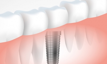 Implants dentaires