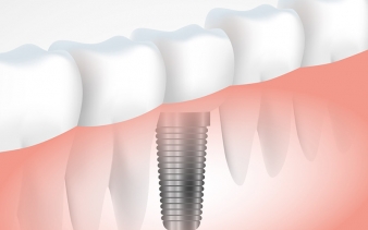 Implants dentaires Implants dentaires